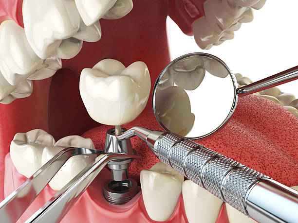 Best Emergency Tooth Extraction in Lake Winnebago, MO